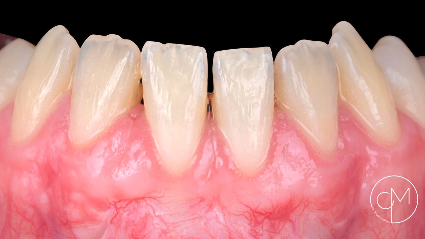 Après traitement – Traitement des récessions gingivales – Dr Charbit Nice