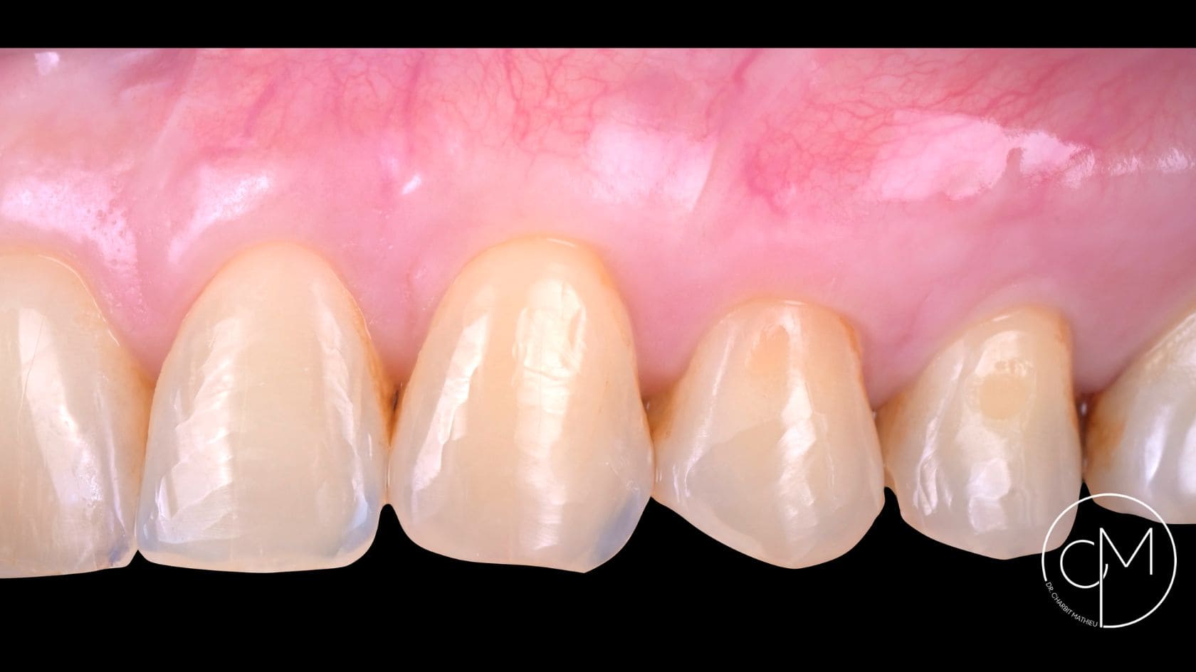 Après traitement – Traitement des récessions gingivales – Dr Charbit Nice