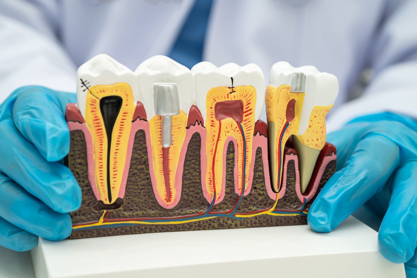 Modèle anatomique dentaire - greffes osseuses et gingivales Nice Dr Charbit