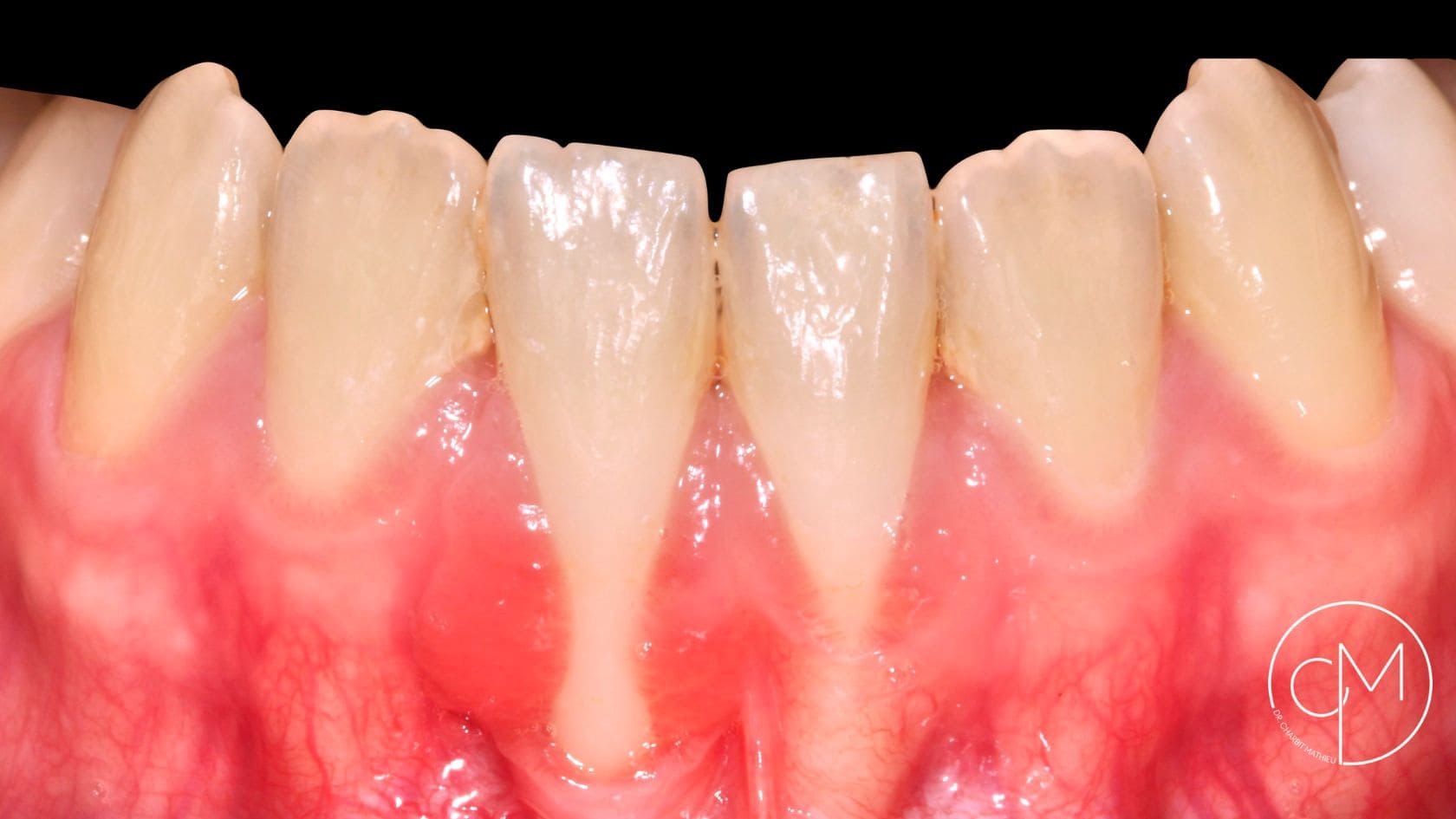 Avant traitement – Traitement des récessions gingivales – Dr Charbit Nice