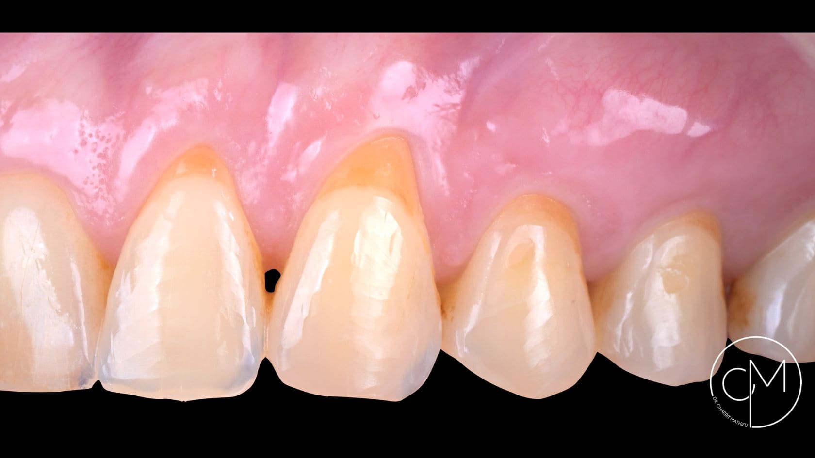 Avant traitement – Traitement des récessions gingivales – Dr Charbit Nice