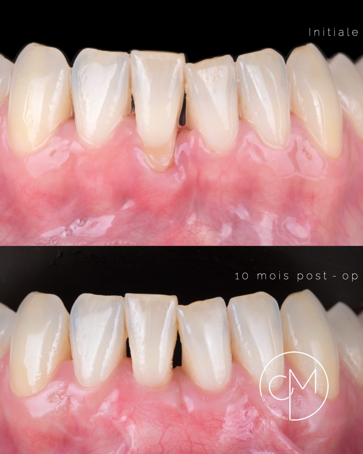 Greffe gingivale Nice, cabinet dentaire Charbit Nice