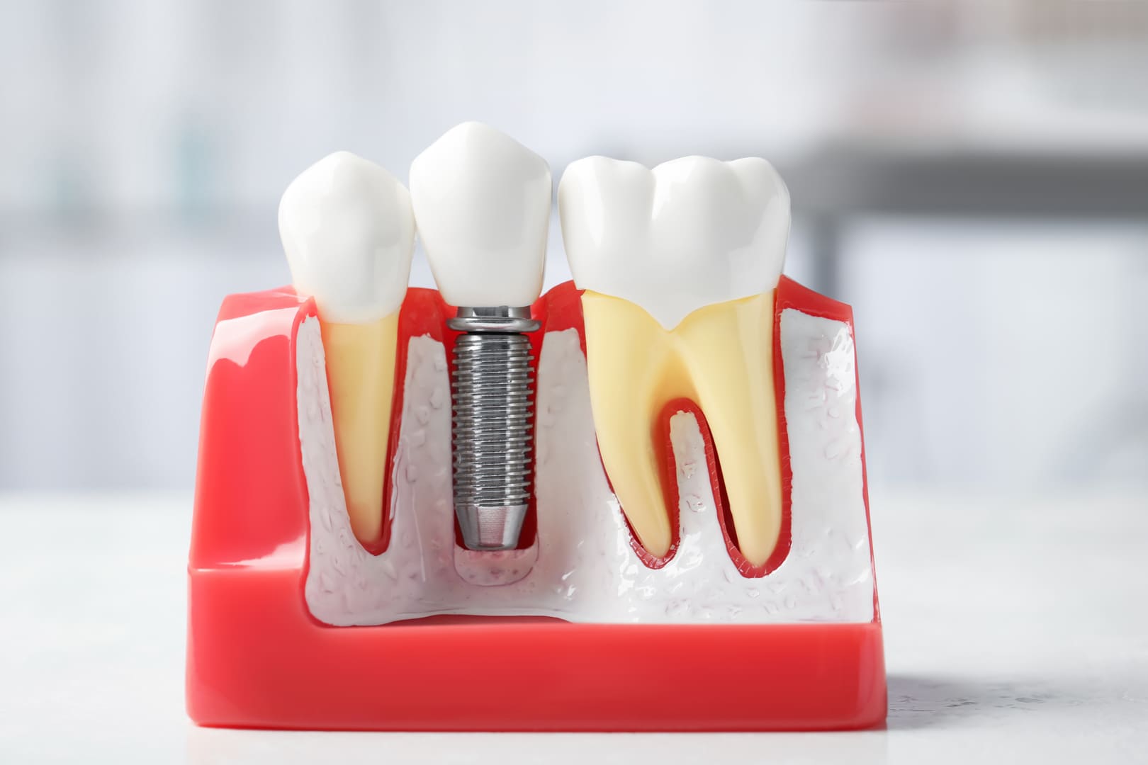 Modèle éducatif implant dentaire dans gencive - cabinet Nice Dr Charbit